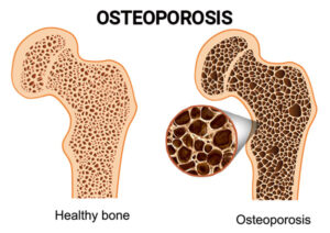 Osteo Image