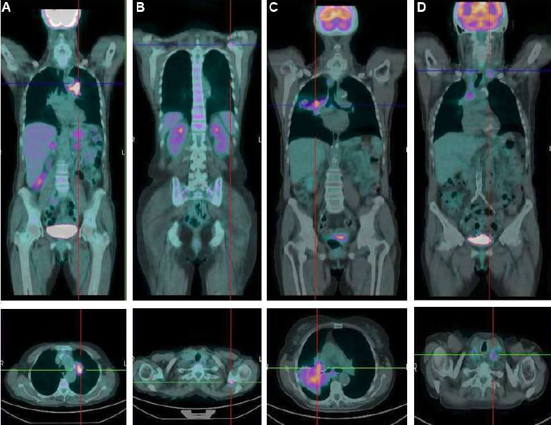 PET/CT (Positron Emission Tomography - St. Francis Only)