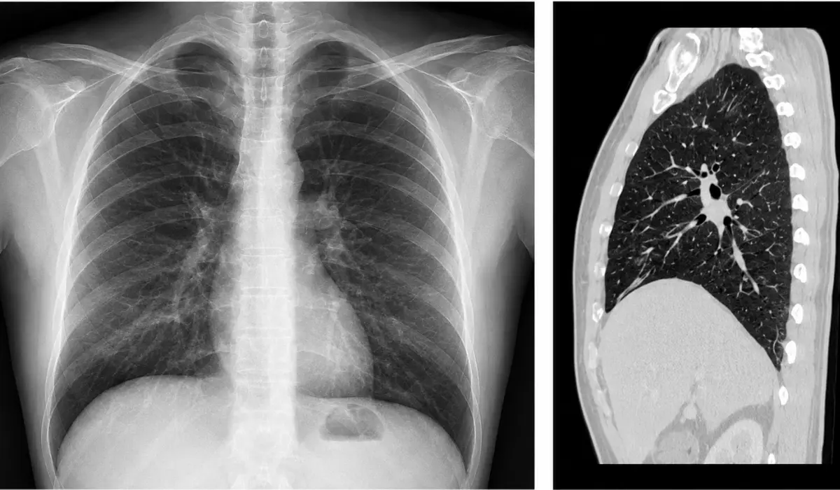 CT Scan Of Lungs: What Patients Should Know Before The Test?