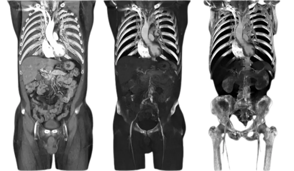 CT Scan of the Pelvis