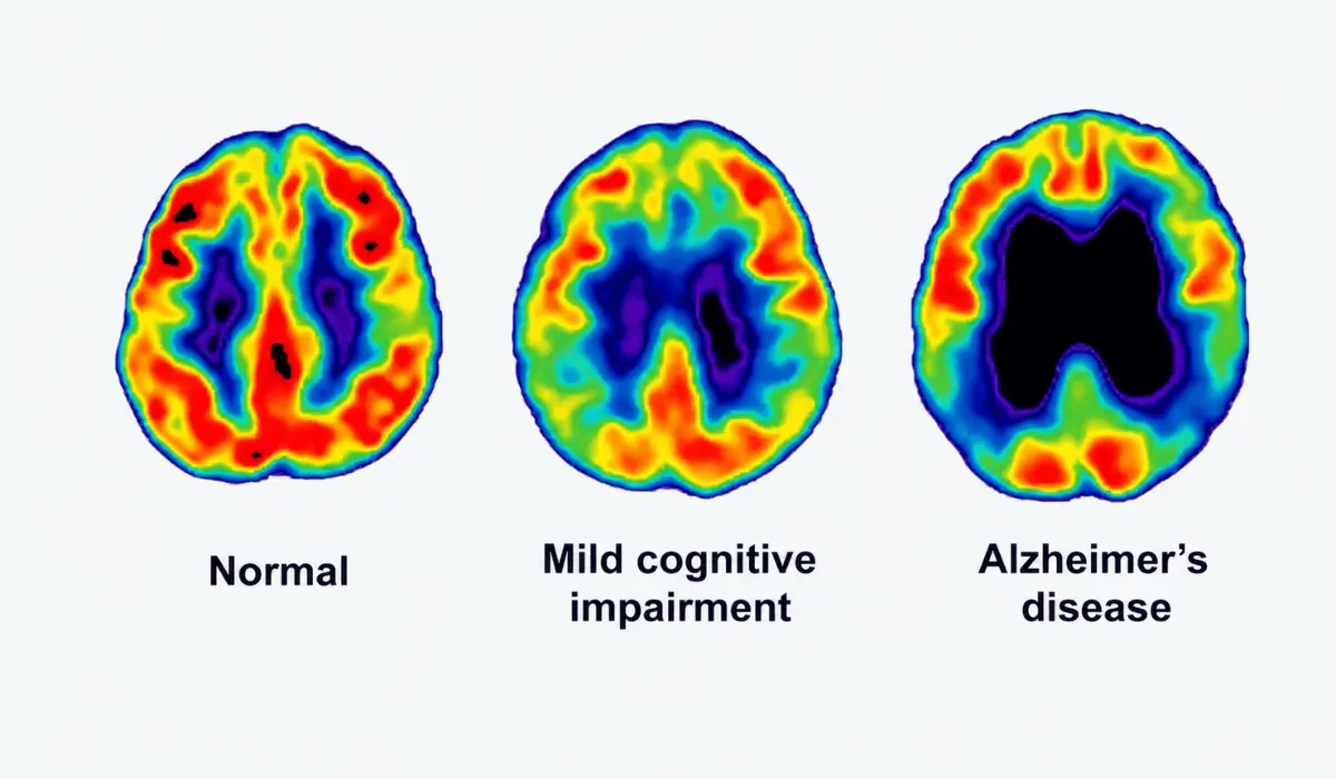 Amyloid PET Scan
