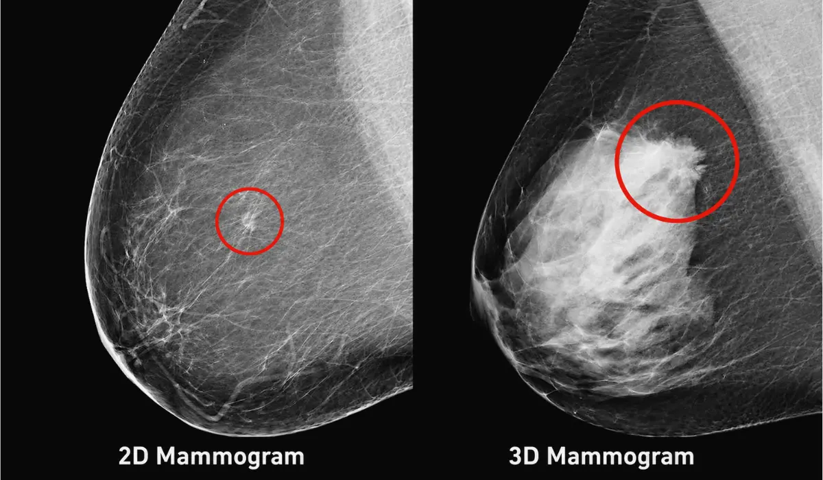 Bilateral mammogram vs. 3D mammogram