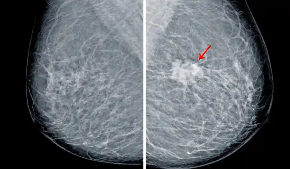 Breast Calcification on Mammogram