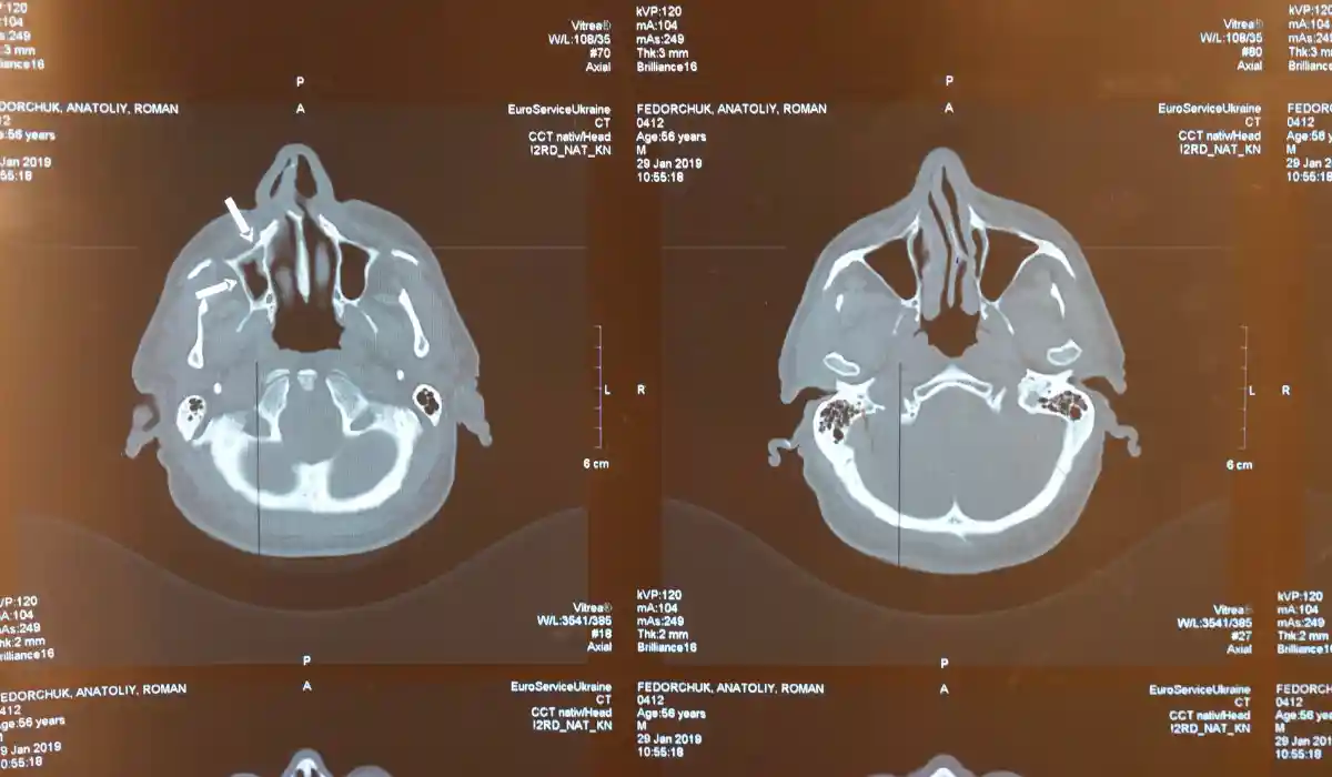 MRA VS MRI