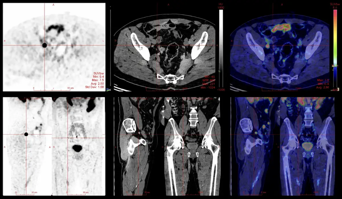 PSMA PET Scan For Prostate Cancer